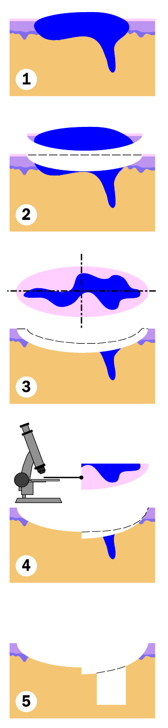 Mohs skin cancer surgery